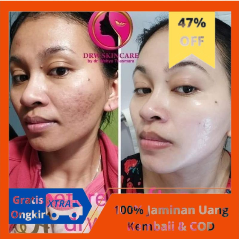 Paket Radiant Acne Brightening Drw Skincare/Cream Bekas jerawat/Acne Cream/Acne Glowing