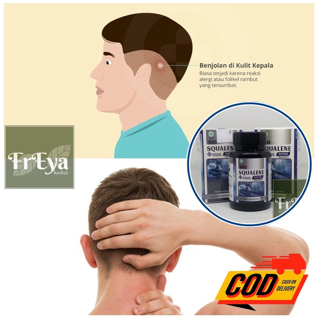 OBAT BENJOLAN DI KULIT KEPALA (BISA COD)