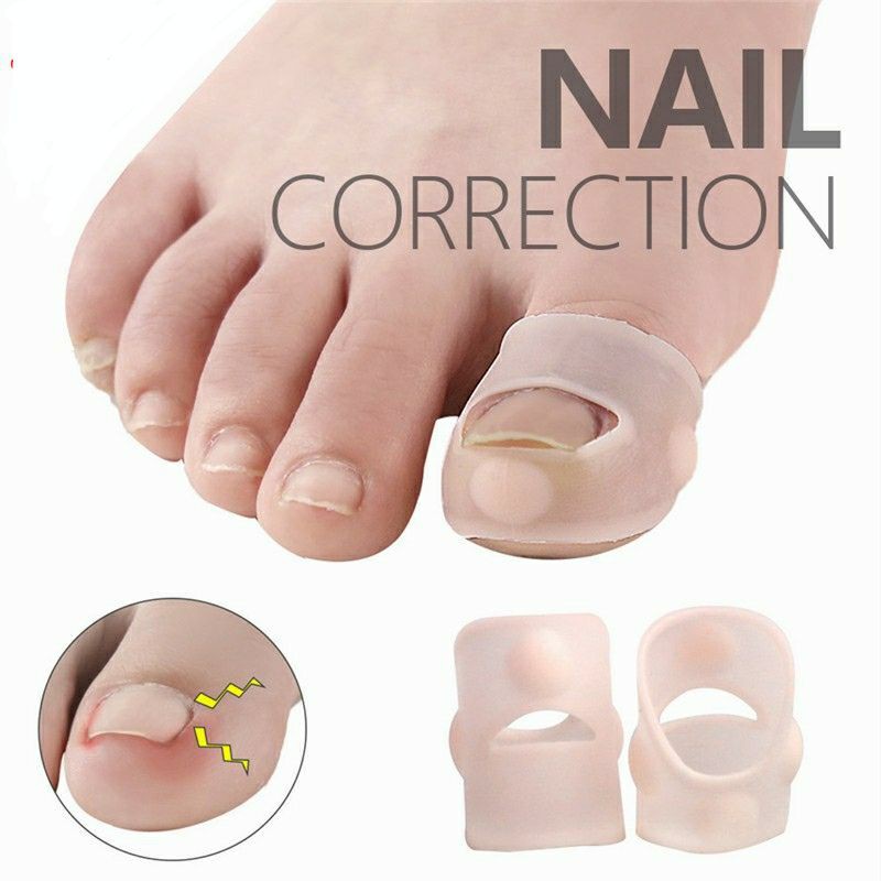 Alat Koreksi Kuku Kaki Tumbuh Ke Dalam Silikon Elastis Cantengan Cantengen Paronikia Paronychia
