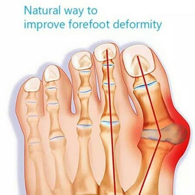 Bunion Elastic Corrector Pelurus jempol kaki nyaman bersepatu