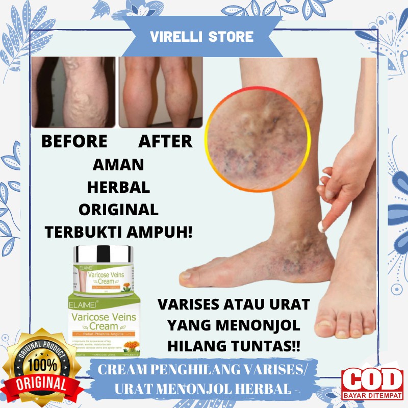 EFEKTIF Permanen Krim Varises Cream Varises Angiitis Salep Flebitis Kaki Krim Varises
