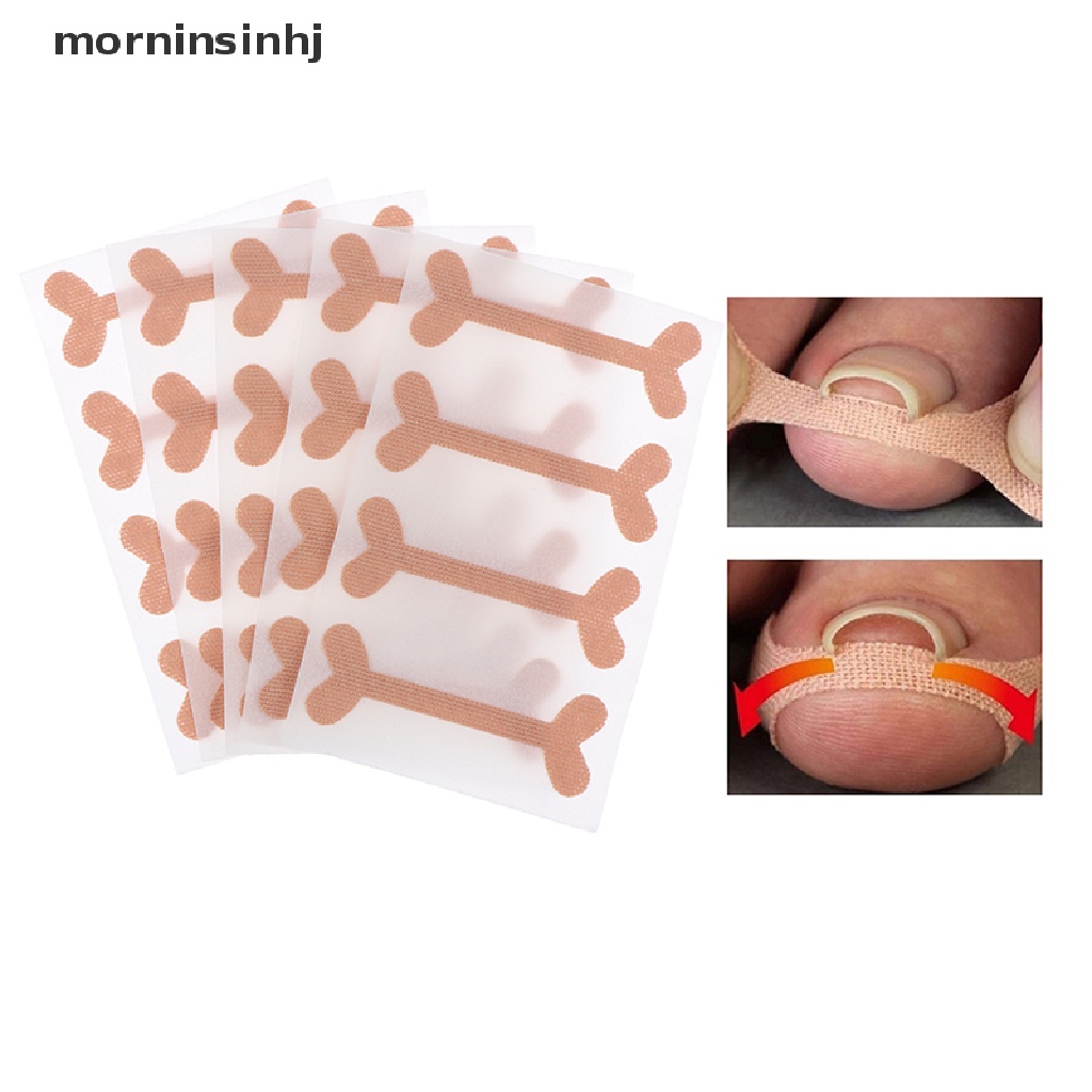 Mornin 5 Lembar Plester Koreksi Kuku Kaki Ingrown Elastis Untuk Pedicure