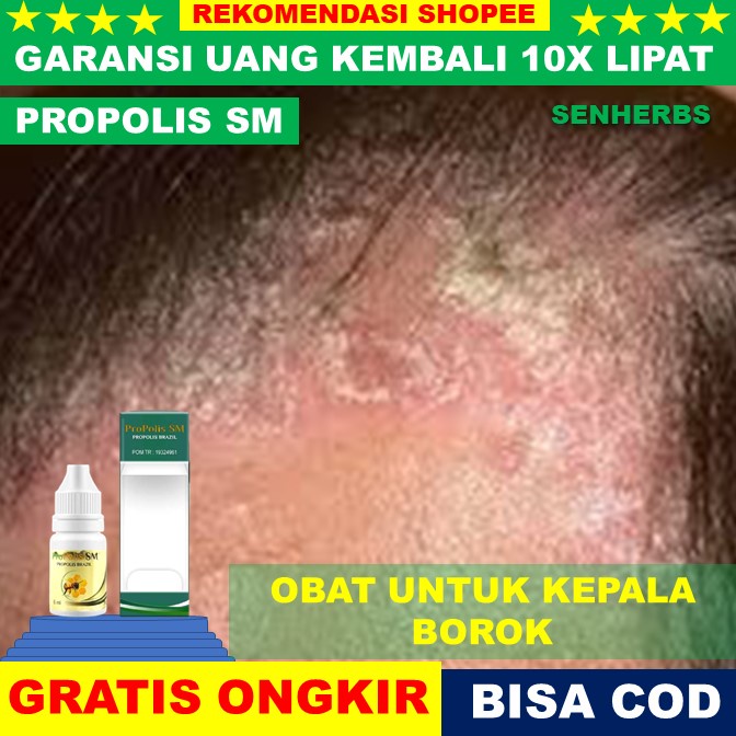 obat kepala borok Obat Borok Kepala, Bernanah, Jamur Kepala, Infeksi Kepala - Herbal Propolis Sm Oba