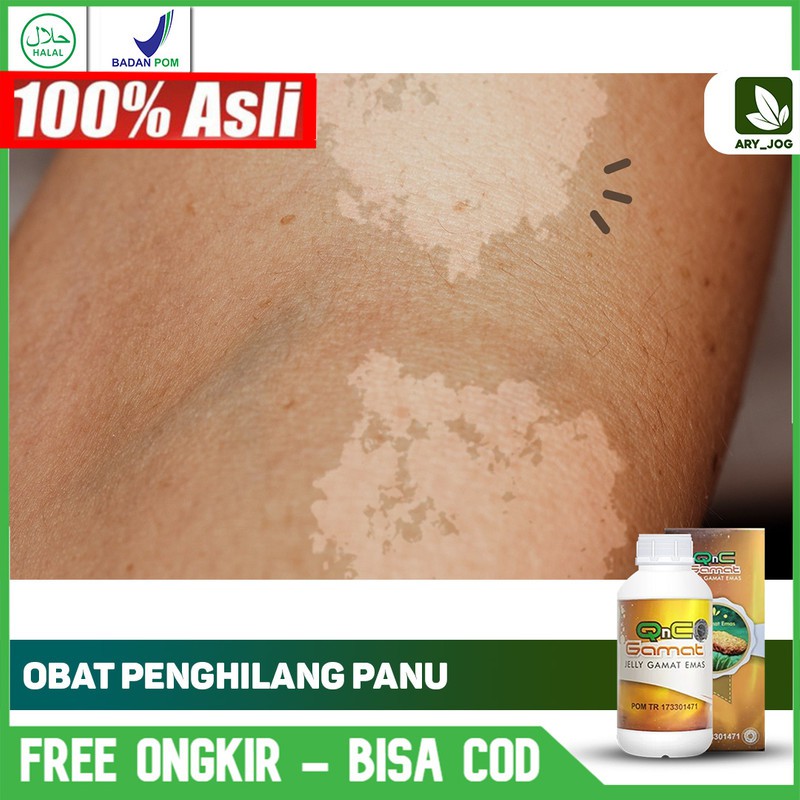 

Obat Panu, Kadas Kurap Jamur, Ruam Merah, Di Kulit Dengan Herbal Alami Qnc Jelly Gamat Aman