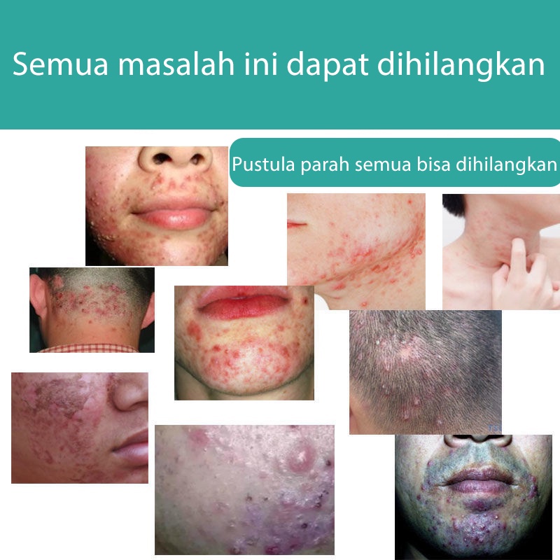 obat jerawat 20g obat jerawat dan bekas jerawat totol jerawat obat jerawat dan bekas jerawat paling ampuh obat totol jerawat Menghilangkan jerawat dengan lembut/mengatur sekresi minyak/mencegah penuaan kulit/mempercepat penyembuhan luka