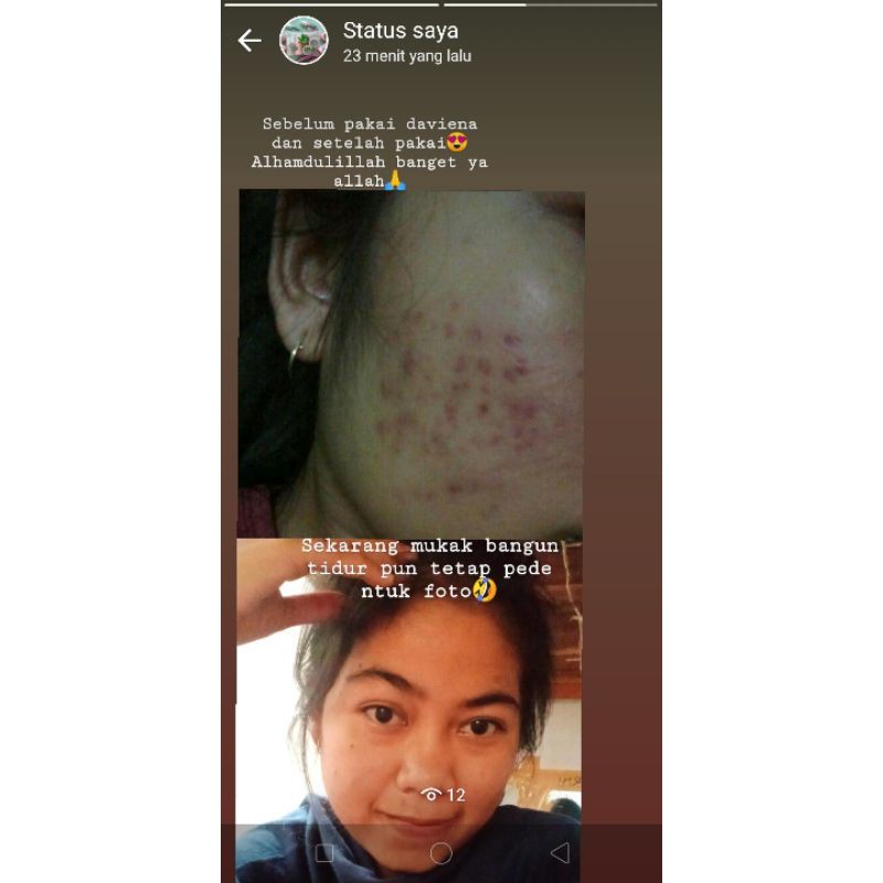 DAVIENA SKINCARE ACNE SERIES|DISTRIBUTOR DAVIENA|BEST SELLER|davienaskincareofficial|ramadhanidavin|davienaskincarejakarta|davienaskincaresurabaya|vidbeauty|davienaskincarejambi