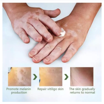 Sumifun Cream Salep Vitiligo Antibakteri Vitiligo White Spot Repigmentation - Salep Krim Penghilang Vitiligo Bintik Putih