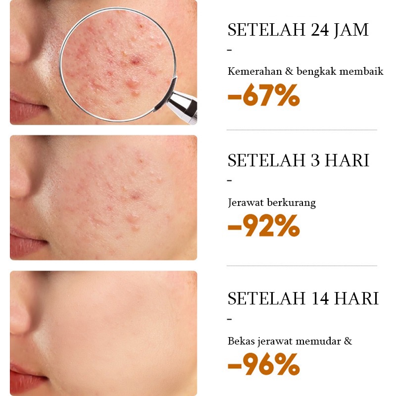 Serum Cream penghilang jerawat Gel Perawatan jerawat Cream untuk jerawat 30g Memperbaiki Menenangkan dan memperbaiki jerawat Kulit berjerawat Kulit halus Lembut dan tembus pandang