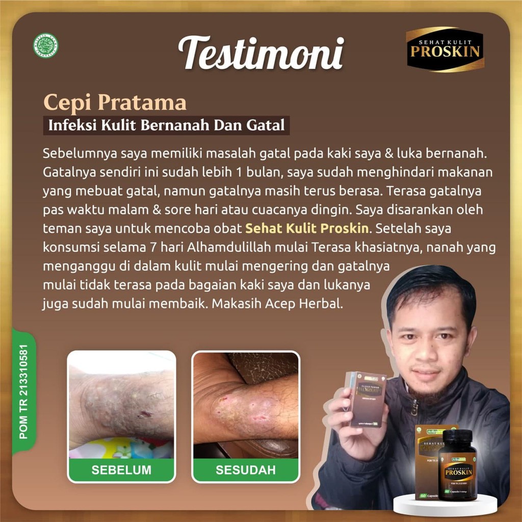 Obat Badan Gatal-Gatal, Obat Gatal Gatal Seluruh Badan, Obat Gatal Alergi, Obat Gatal Menahun, Obat Kulit Bersisik, Obat Gatal Kulit, Obat Gatal Merah-Merah, Obat Psoriasis, Obat Eksim Kering, Obat Gatal Berair, Obat Koreng Gatal Dengan Proskin