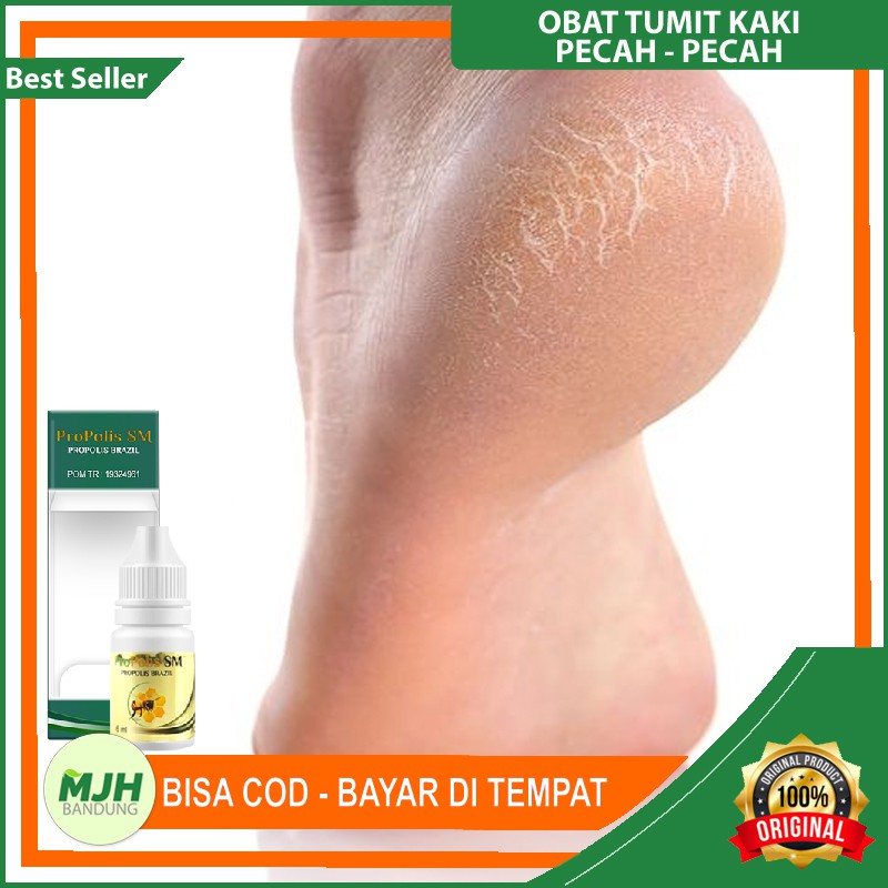Obat Tumit Kaki Pecah Pecah / Rorombeheun / Roromeheun Parah