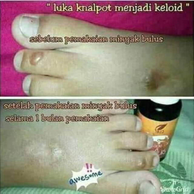 Ampuh atasi keloid/OBAT LUKA BAKAR/obat keloid