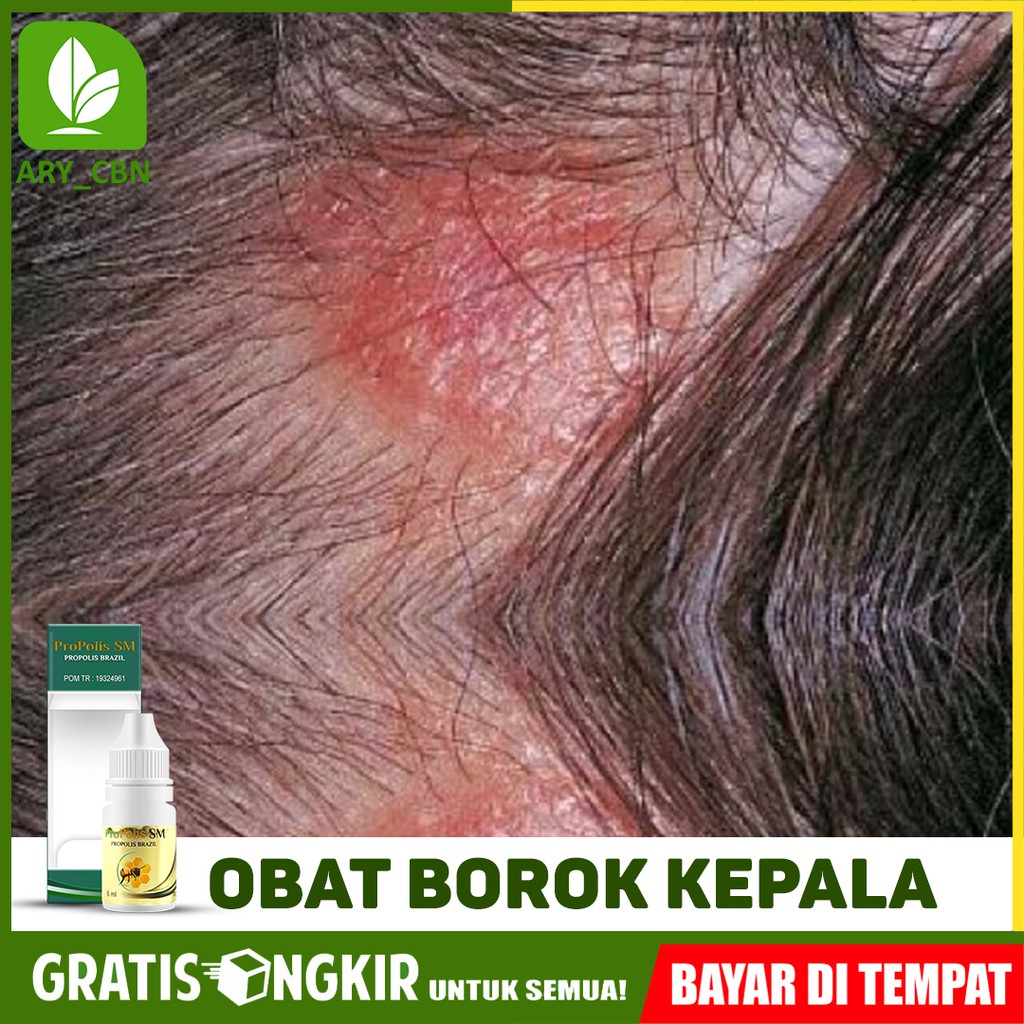 

Obat Borok Kepala Bernanah Jamur Kepala Infeksi Herbal Propolis SM Brasil Bisa COD Di Cirebon