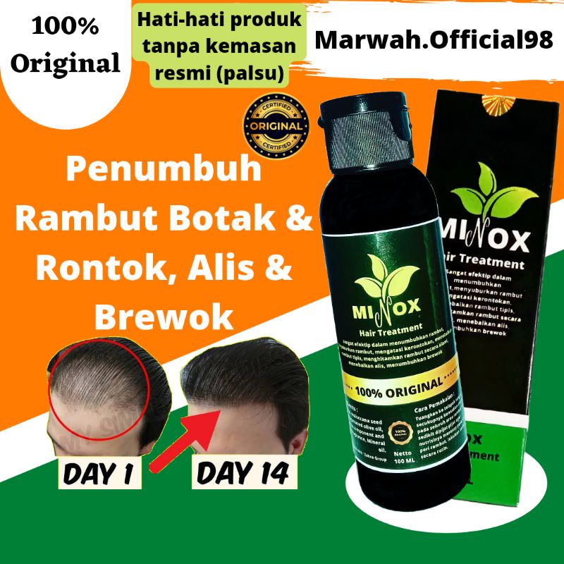 Jual [MINOX] Obat Penumbuh Rambut Botak, Tipis dan Rontok Super Cepat