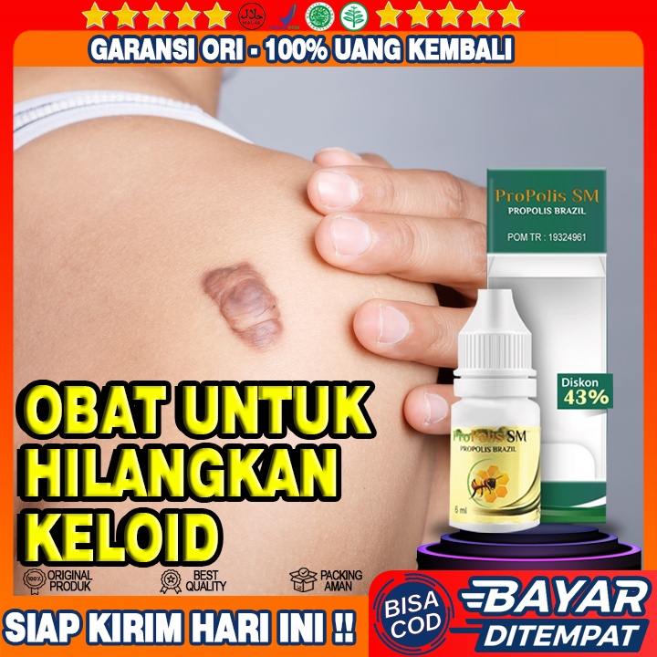 Jual Obat Untuk Menghilangkan Keloid Yang Sudah Lama Keloid Bekas Sc Oles Keloid Salep Keloid 0283