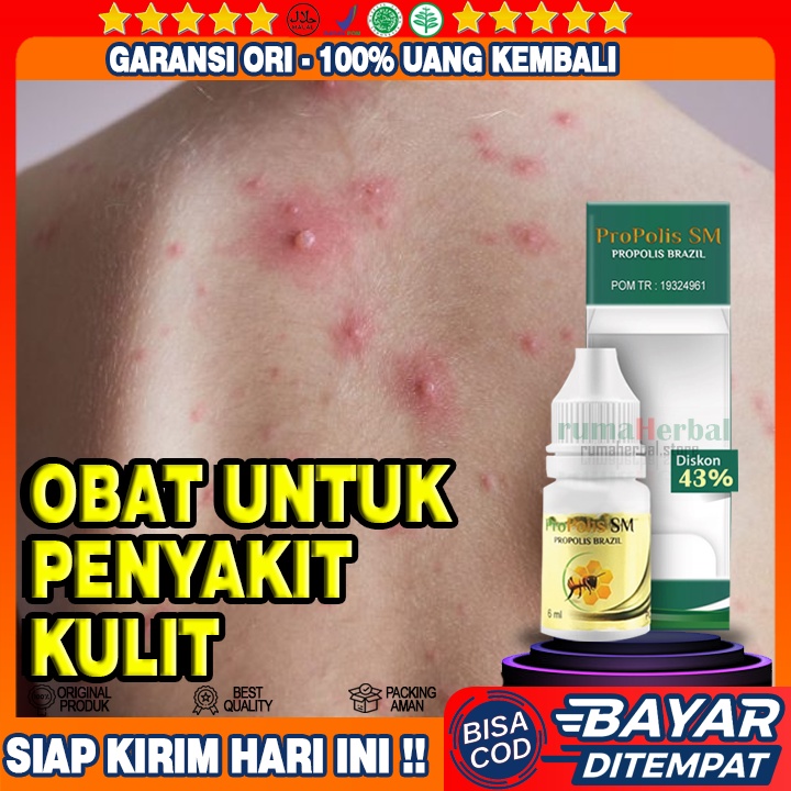 Obat Penyakit Kulit Untuk Anak, Obat Herpes, Obat Gatal Gatal, Obat  Keluar Bentol, Obat Kulit Merah