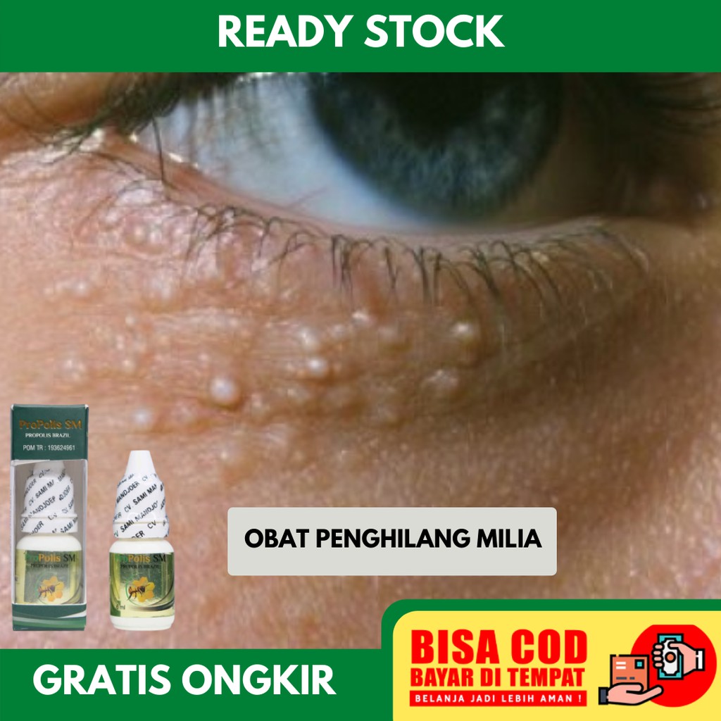 Obat untuk Milia Pada Wajah - Skincare untuk Menghilangkan Milia - Obat Milia - Obat Milia di Wajah 