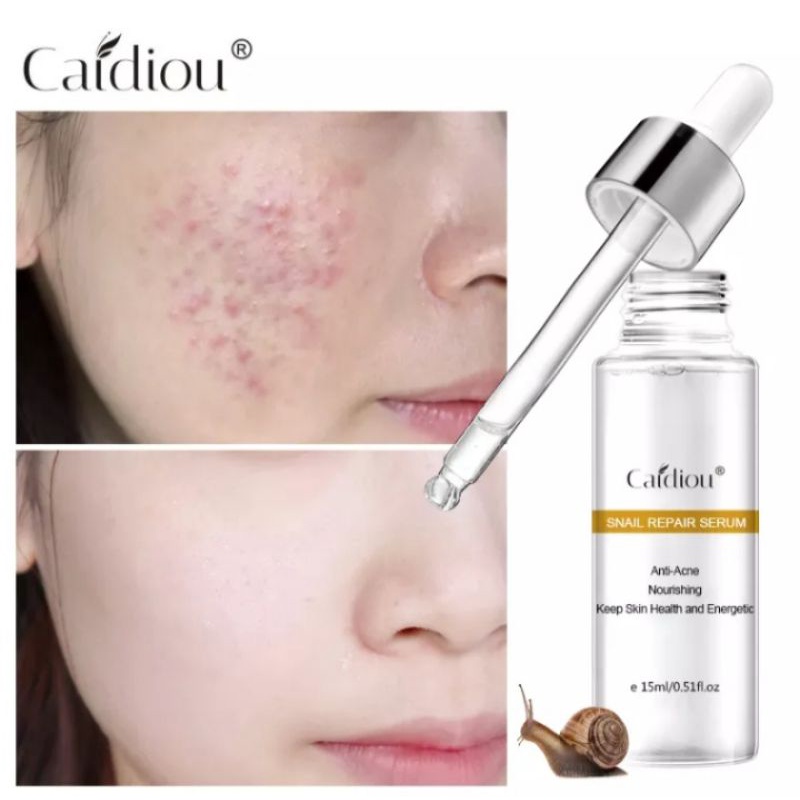 CAIDIOU SERUM SIPUT TREATMENT JERAWAT, ALERGI, KULIT RUSAK