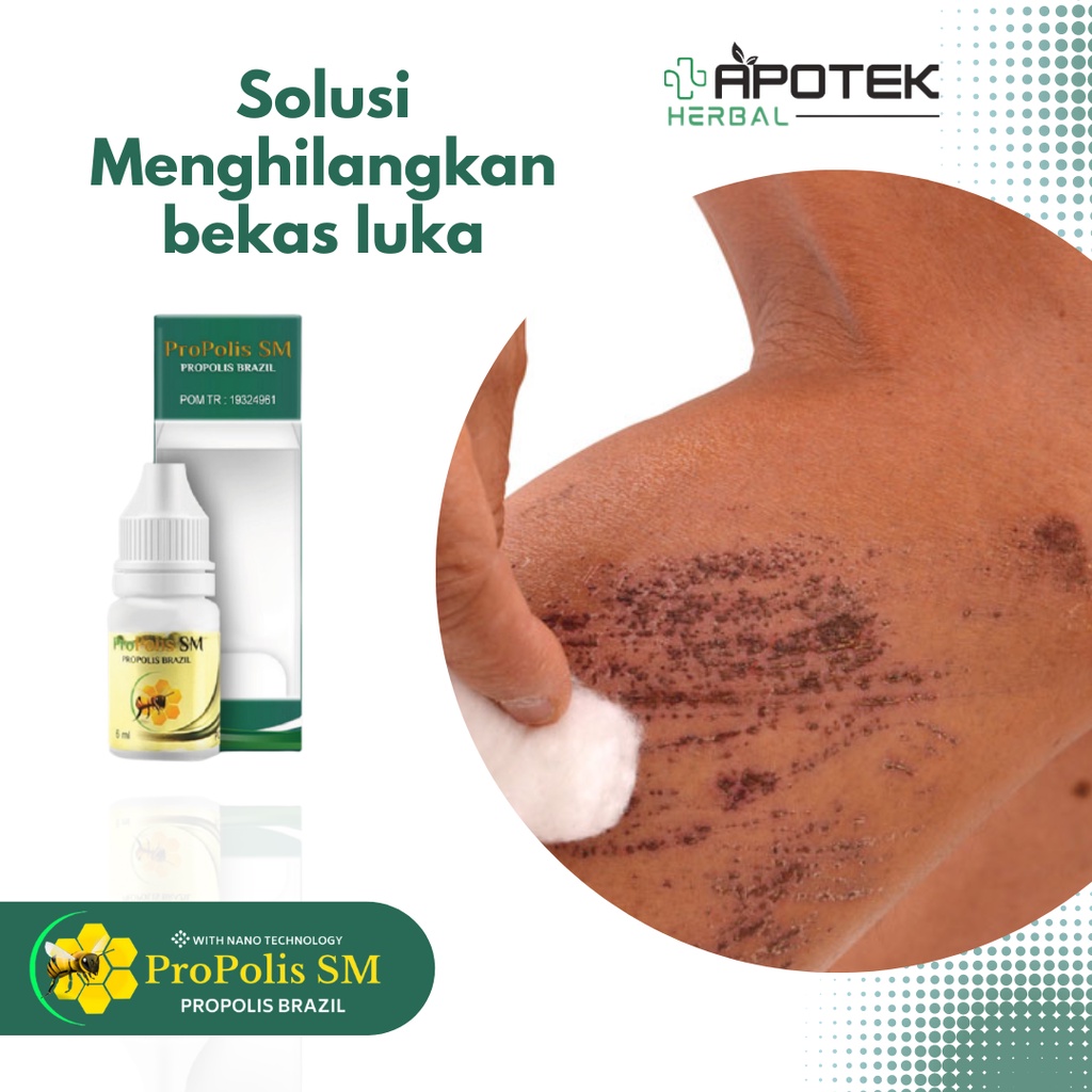 Obat Penghilang Bekas Luka, Obat Penghilang Bekas Koreng, Obat Penghilang Bekas Luka Gatal, Obat Pen