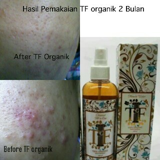 Obat Jerawat Ampuh Organik Original 100ml