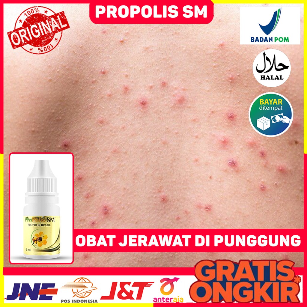 Obat Jerawat di Punggung - Obat Jerawat di Pundak - Obat Jerawat Kecil - Obat Jerawat Batu - Obat Pe