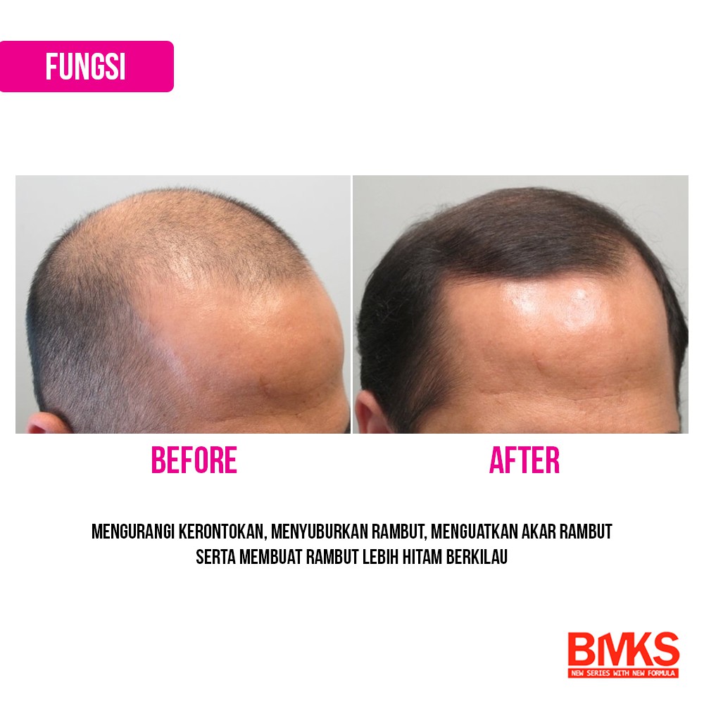 BMKS Hair Tonic Minyak Kemiri BMKS Natural BPOM Original - BMKS TONIC KPR-12