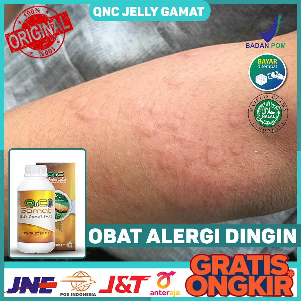 Jual Obat Alami Alergi Dingin Gatal Kulit Gatal Gatal Bersin