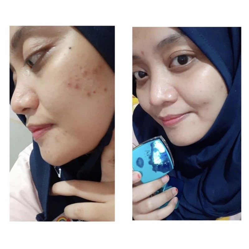 ACNE SERIES DAVIENA SKINCARE