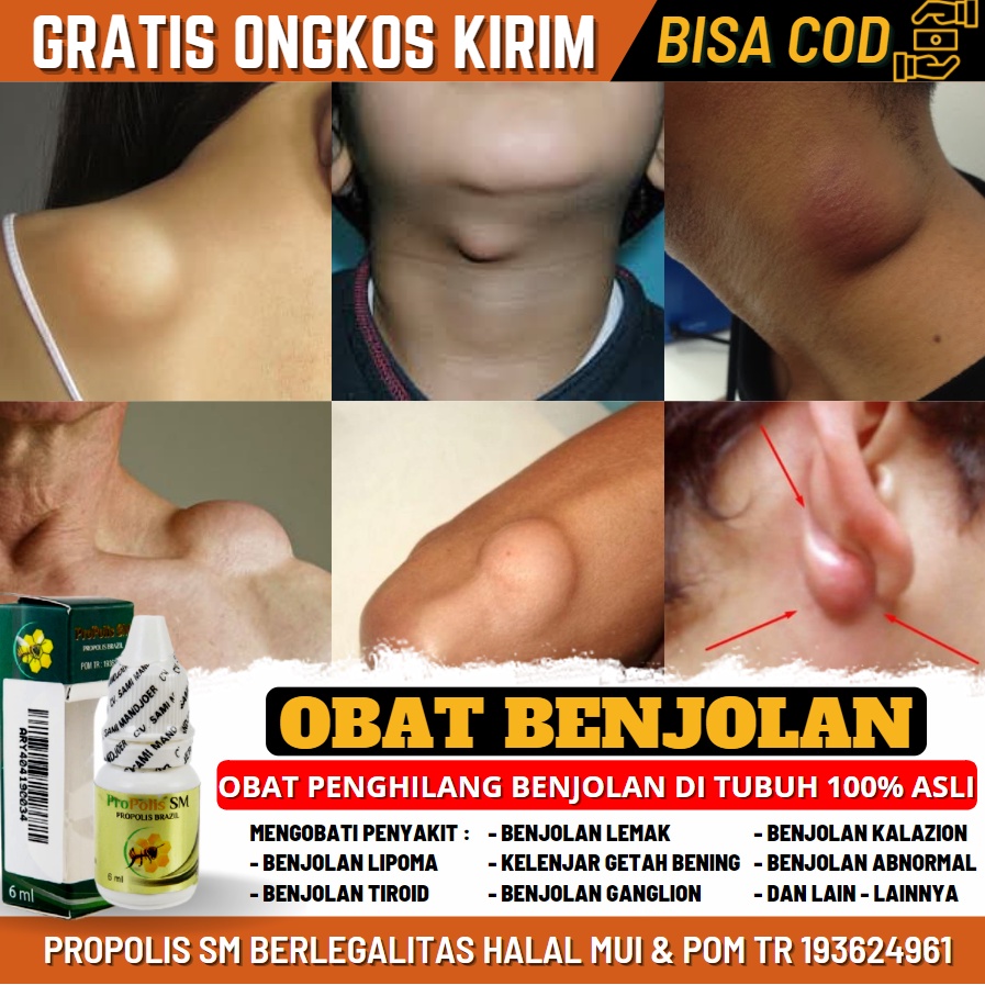 Obat Penghancur Benjolan di Tangan, Benjolan Ganglion Dan Lipoma di Tangan, Obat Oles Propolis SM