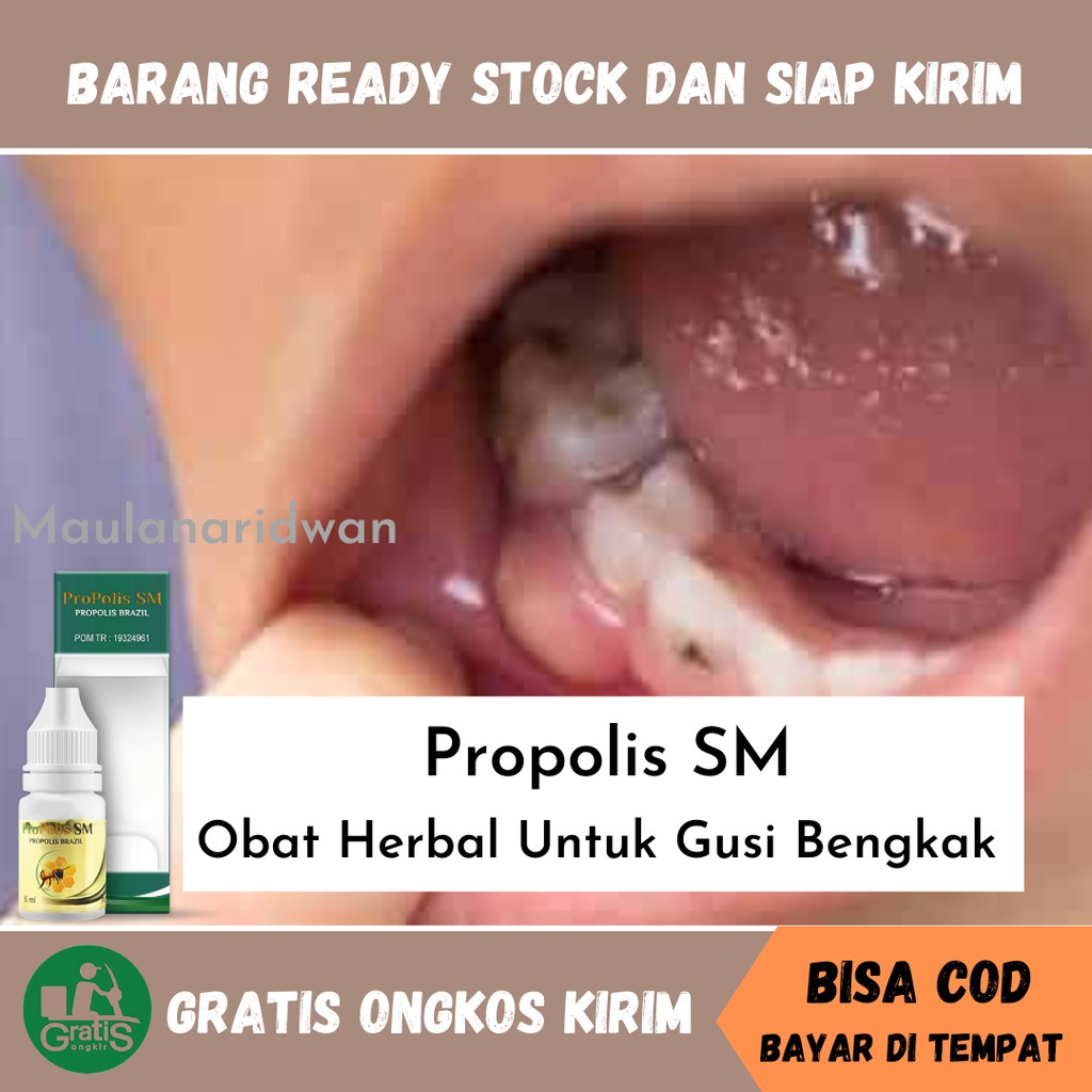 Obat Gusi Bengkak, Nyeri Gusi, Infeksi Gusi, Gusi Turun, Abses Gusi, Obat Alami Gusi Berbarah - Prop