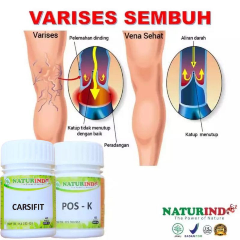 Obat Varises Ampuh Parises Kaki Obat Varises Kaki Ampuh