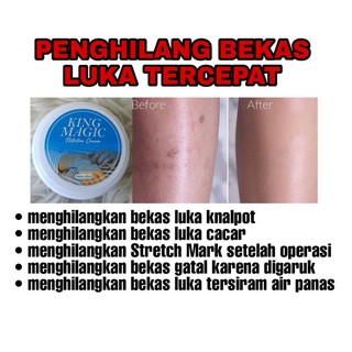 Obat Bekas Luka Akibat Darah Manis Herbal 100 Alami Ampuh Shopee Indonesia