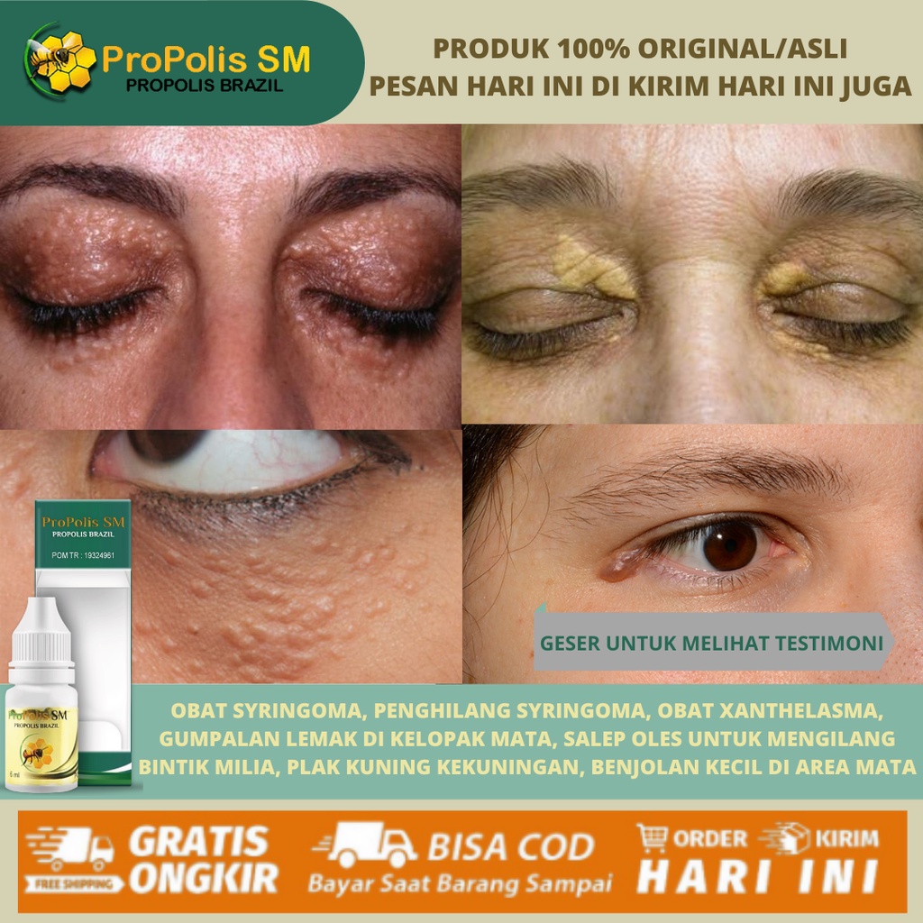 Obat Milia, Penghilang Bintik Putih Milia di Bawah Mata, Milia di Kelopak Mata, Beruntusan di Wajah,