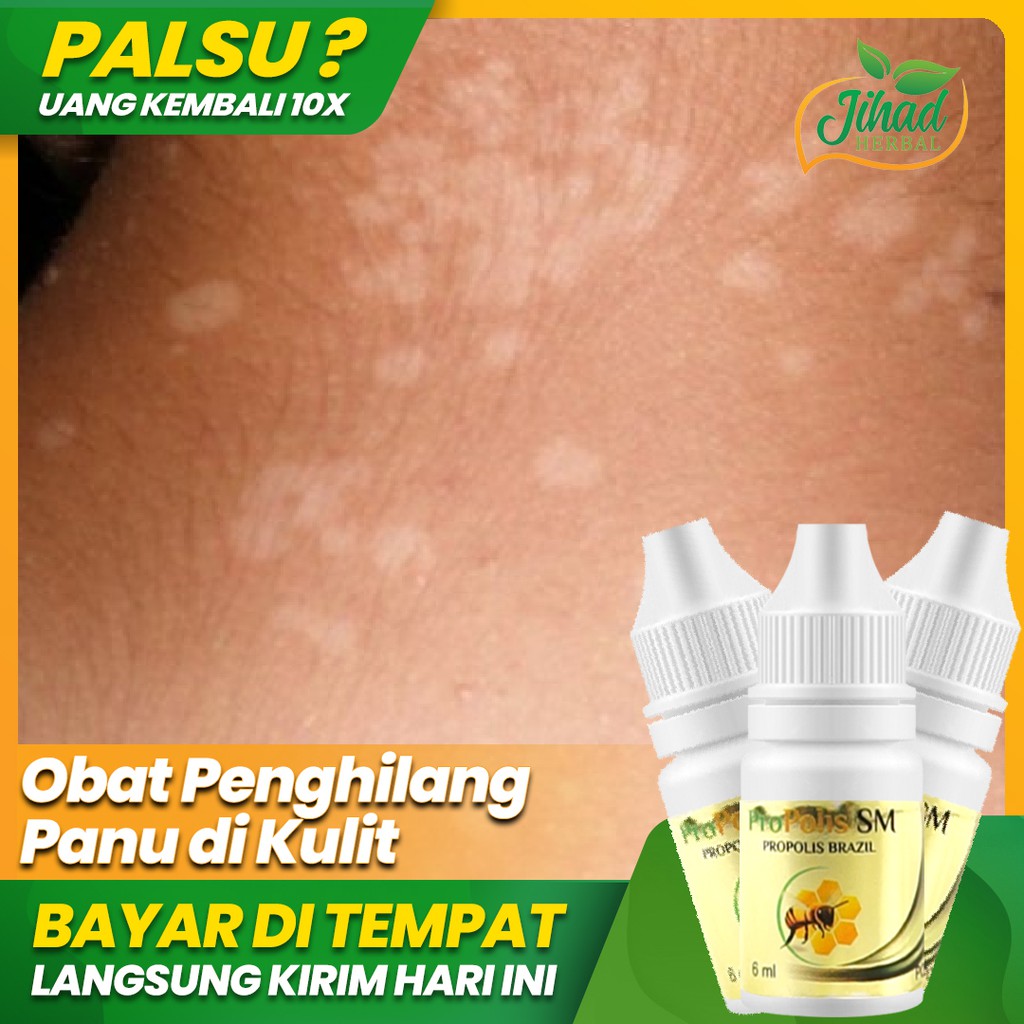 PROPOLIS SM Obat Untuk Panu, Jamur Kulit, Gatal Gatal Seluruh Badan, Gatal Selangkangan