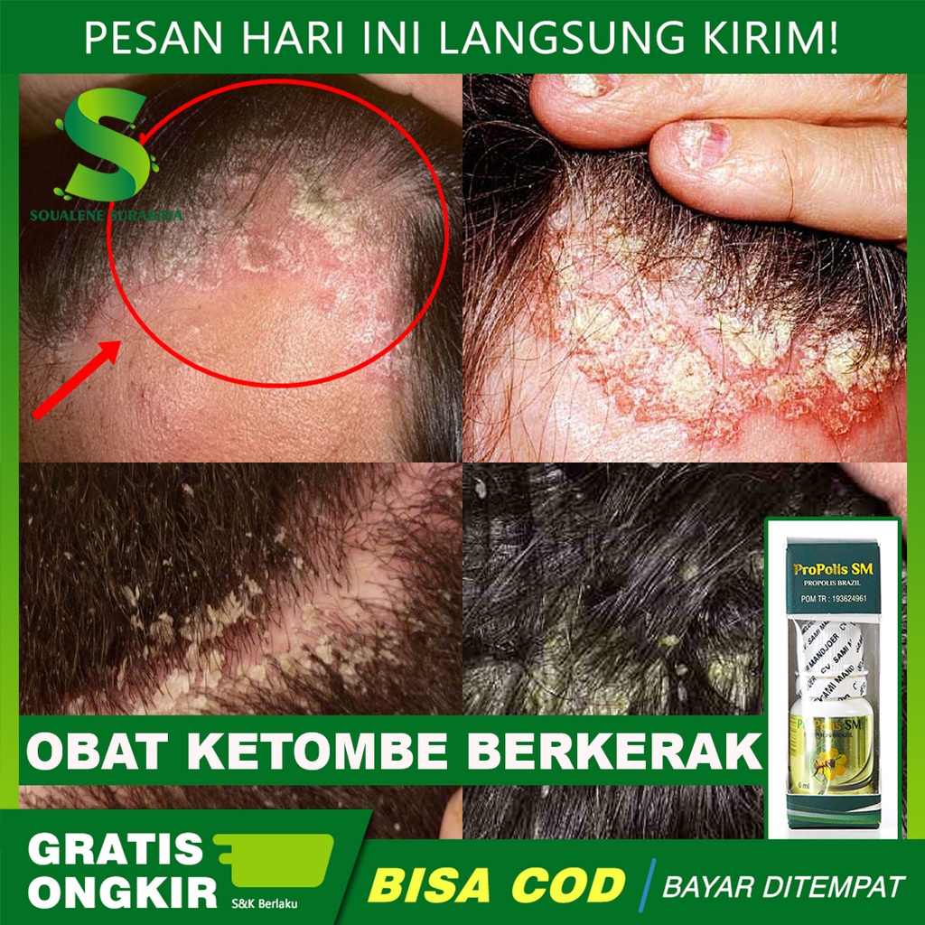 Obat ketombe Berkerak - Ketombe Bersisik - Ketombe Parah - Ketombe Gatal Parah - Atasi Dengan Propol