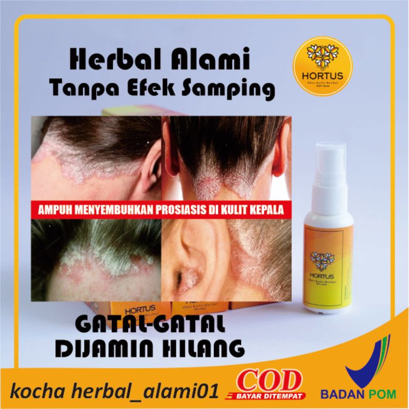 Jual Obat Anti Ketombe Gatal Kurap Jamur Jerawat Kutu Air Penghilang ...