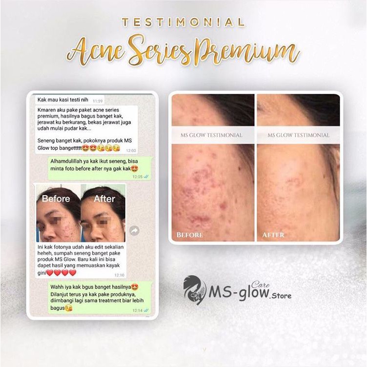 Acne Series Khusus Jerawat Ms Glow Original Perawatan Aman Dan Skincare Bpom Shopee Indonesia