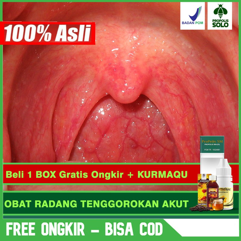 

Obat Radang Tenggorokan Akut, Kronis, Alami Propolis SM Brazil Di SOLO Bisa COD