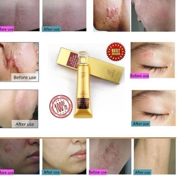 [L4ngsung K!r!m] LANBENA CREAM PENGHILANG BEKAS LUKA/BEKAS JERAWATAN/BEKAS BOPENG ORIGINAL,,,sU3.CDE