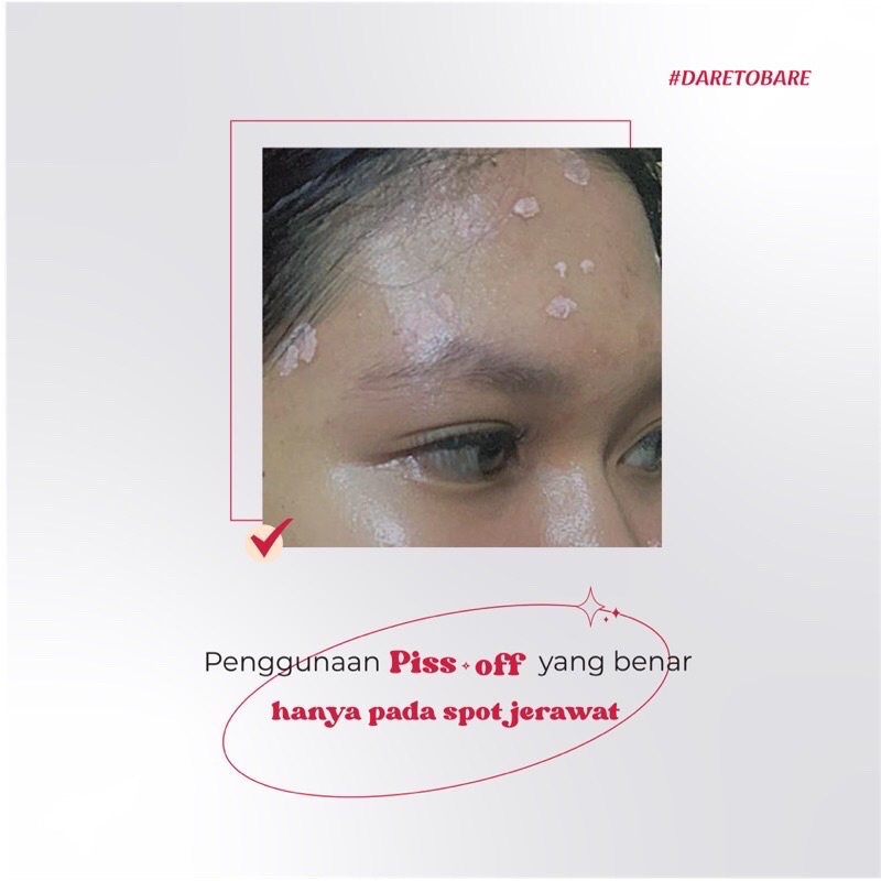 PRETTYWELL PISS-OFF BLEMISH SPOT CREAM (ACNE SPOT)