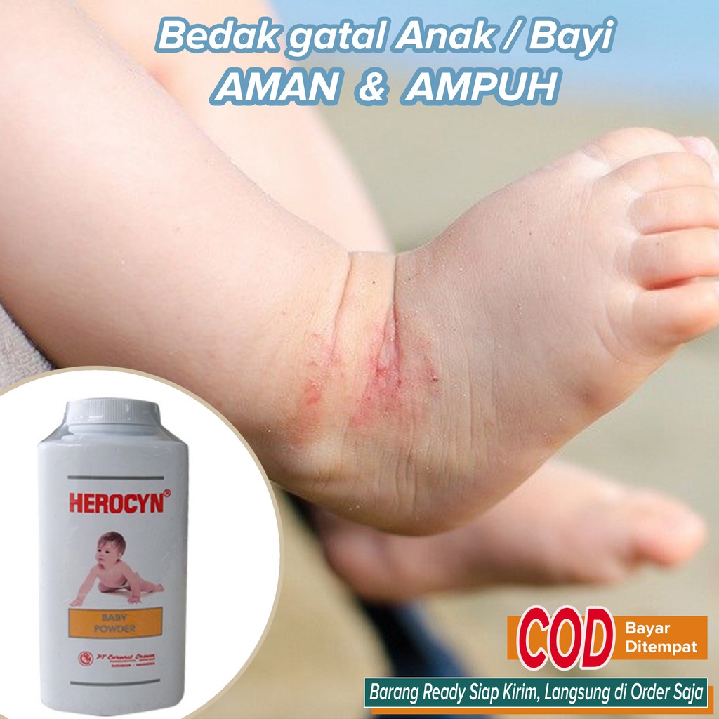 Obat Bedak Gatal Kulit Bayi ANAK Gatal Kulit Biyang Keringat dll ~ Bedak Herocyn Anak 100gr