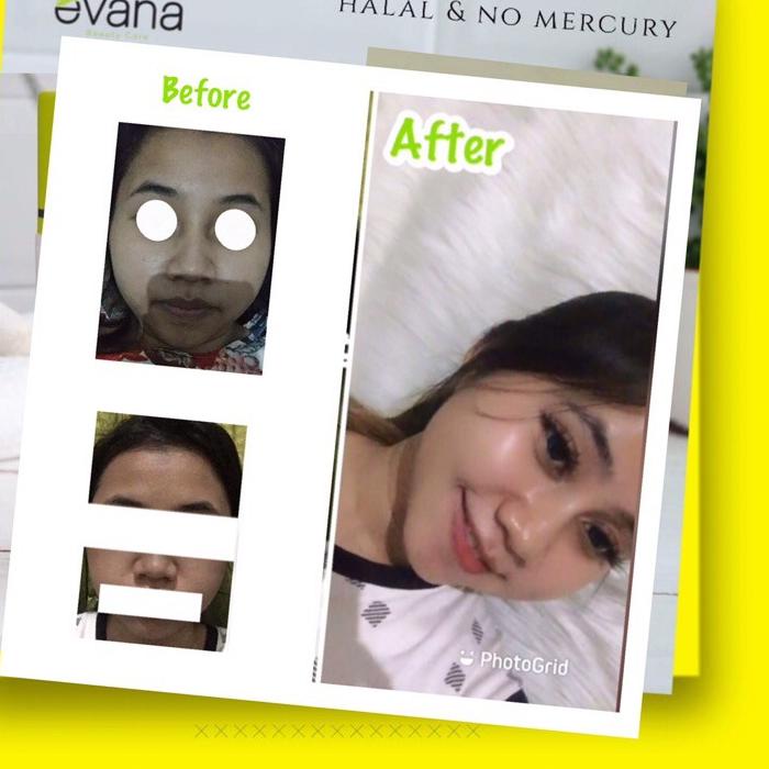 (wajib konsul) Paket Whitening II () evana beauty care