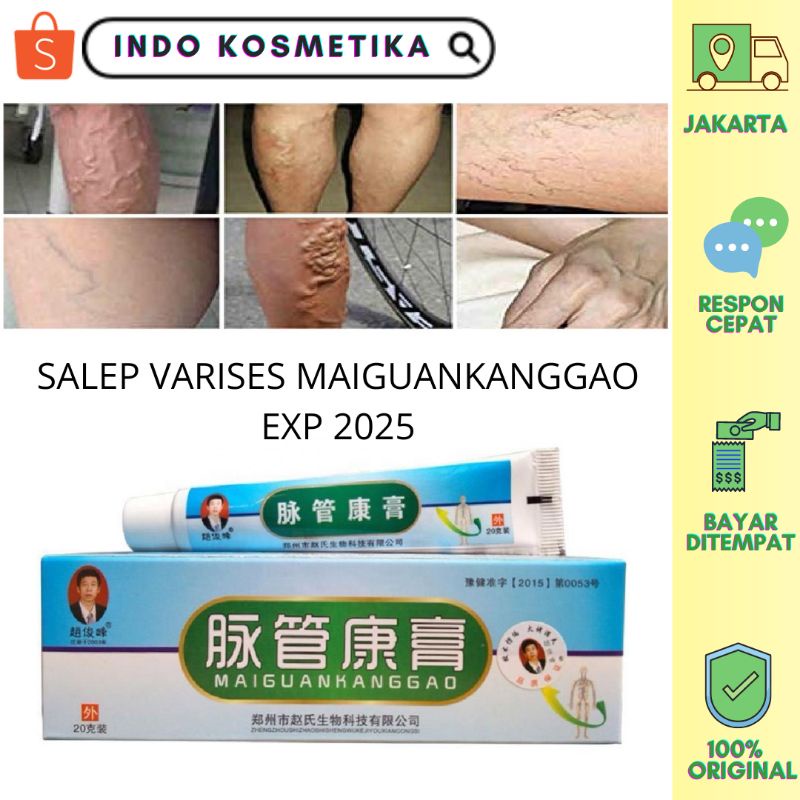 KRIM SALEP VARISES MAIGUANKANGGAO MENGOBATI VARISES