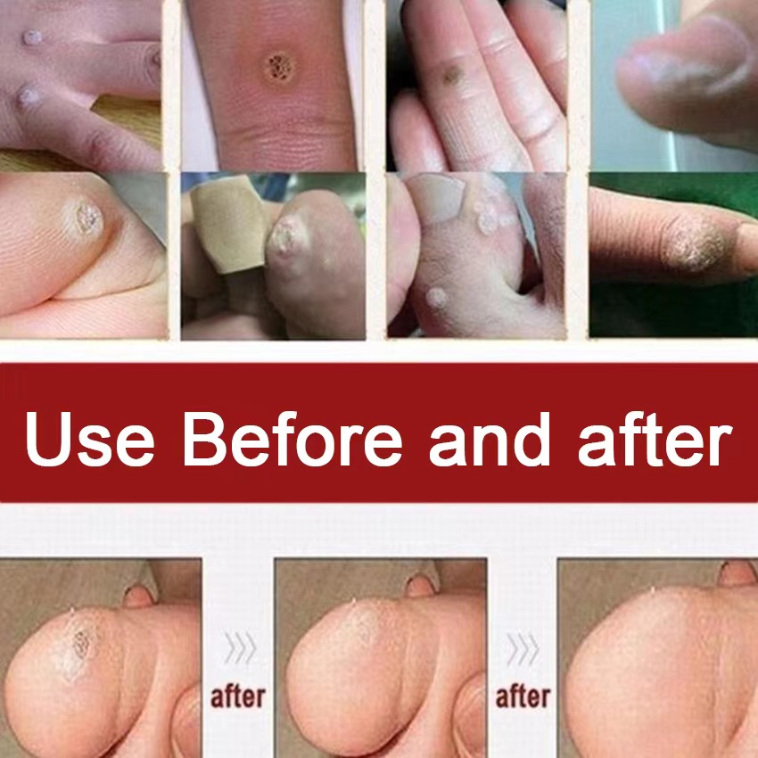 Obat kutil Obat mata ikan Cairan Anti KutilTangan Dan Kaki Menghilangkan Kutil &amp; Skin Tag Cairan Antibakteri Obat
