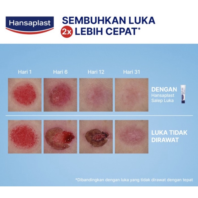 Hansaplast salep luka 20 gram ( salep luka antiseptik )