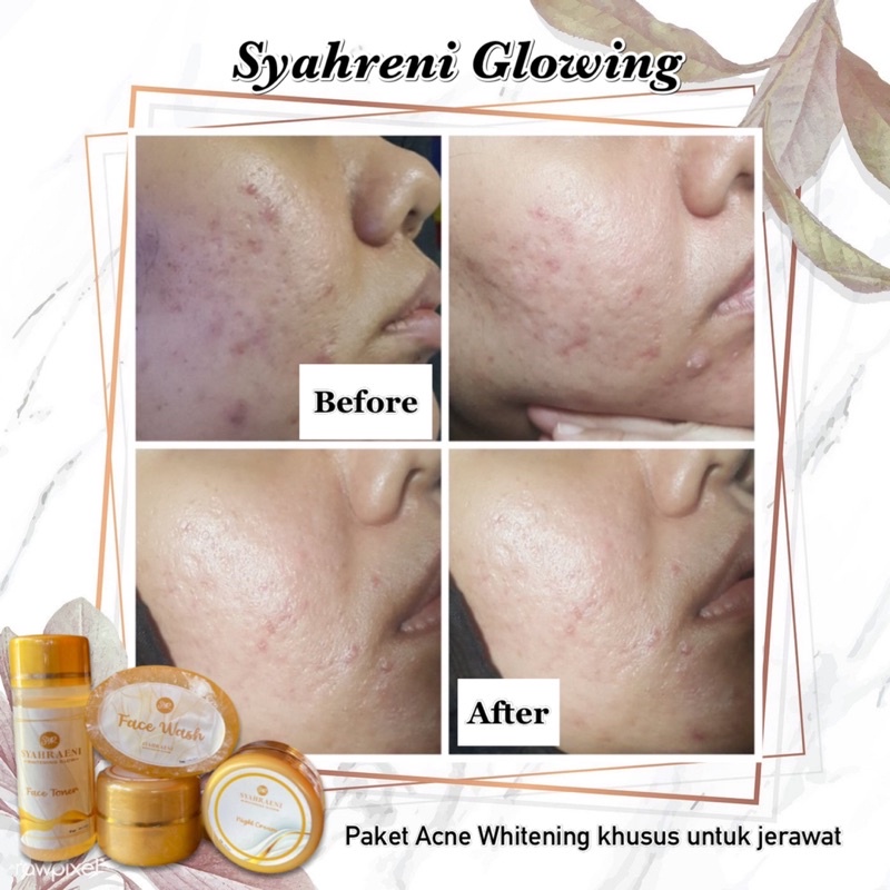 BISA (COD) SYAHRENI PAKET ACNE WHITENING / SYR GLOWING PAKET ACNE ORIGINAL