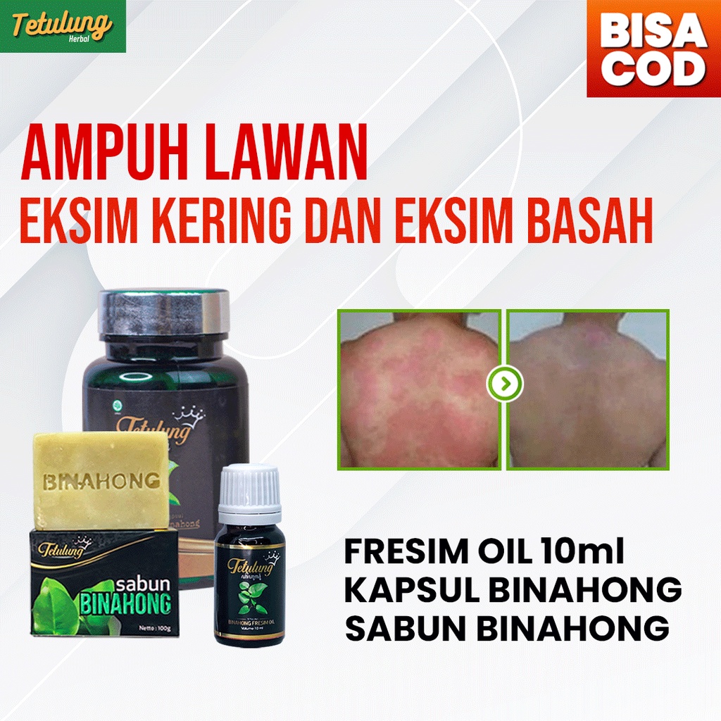 Paket Murah Obat Gatal Eksim Menahun Ampuh Anti Kambuh - Sabun Binahong , Kapsul Binahong , Freshim Oil 10ml