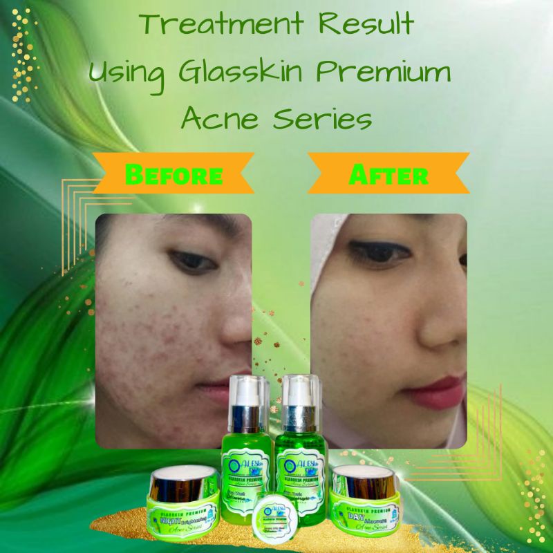 ACNE SERIES GLASSKIN PREMIUM SKINCARE PERAWATAN PEMUTIH WAJAH GLOWING JERAWAT FLEK ALESKIN GLOW