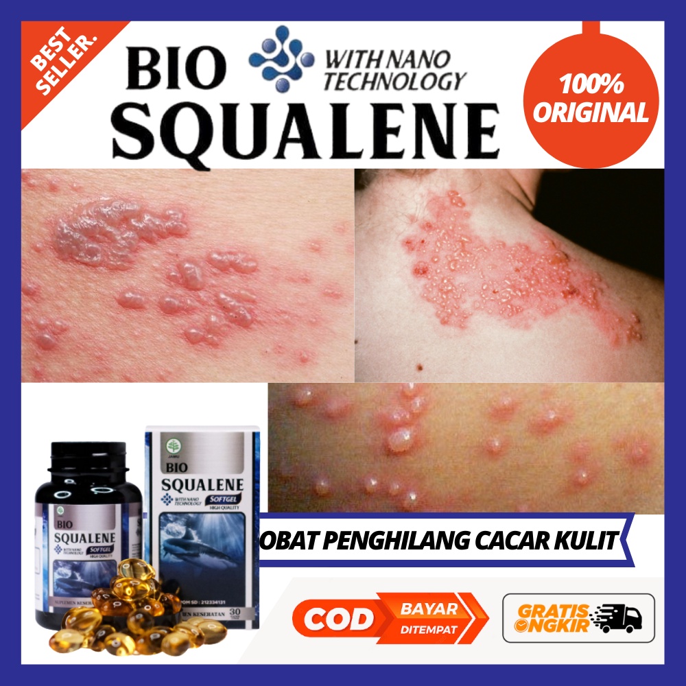 Obat Cacar Air / Cacar Ular Kulit Kering / Cacar Api / Obat Cacar untuk Anak dan Dewasa / Obat Campa