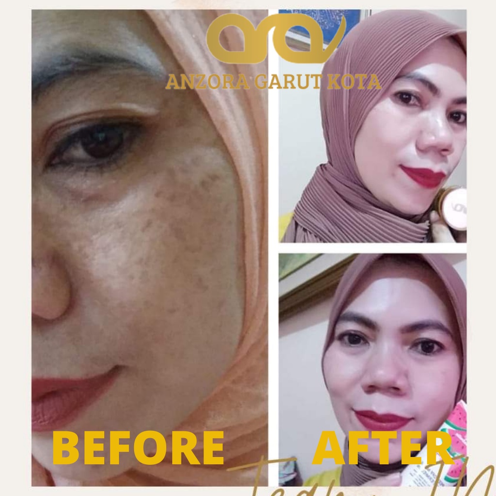 ANZORA ANZORA SKINCARE ANZORA SKINCARE GLOWING ANZORA ACNE ANZORA ACNE DARK SPORT ANZORA SKINCARE ORIGINAL SKINCARE ACNE SKINCARE KECANTIKAN PERAWATAN WAJAH PERAWATAN WAJAH ANZORA BODY LOTION SKINCARE GLOWING SKINCARE WAJAH BERJERAWAT  ANZORA GARUT KOTA-2