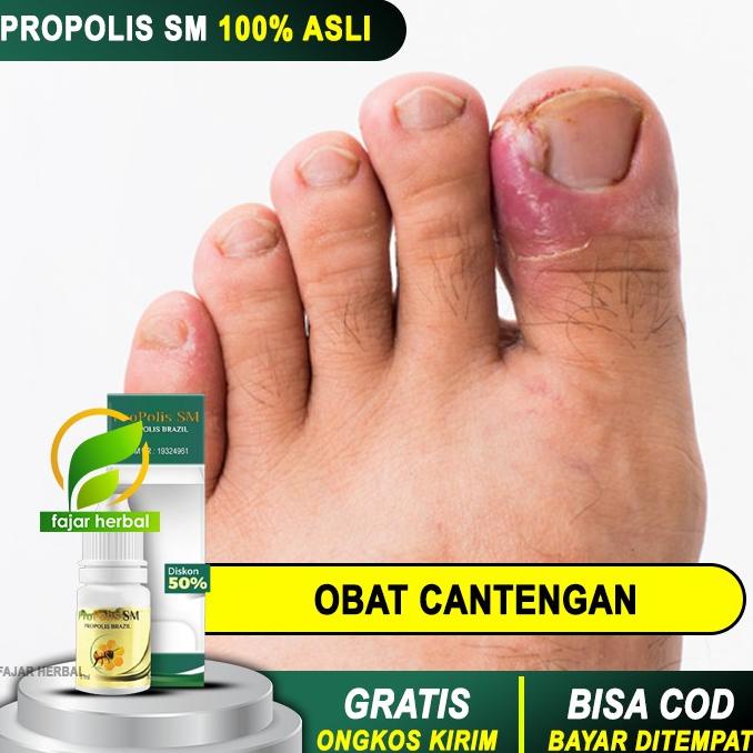 Jual Obat Cantengan Kuku Jempol Kaki Akibat Jamur Tetes Oles